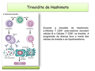 Tireoidite de Hashimoto
http://www.nature.com/nri/journal/v2/n3/images/nri750-f1.gif
Durante a tireoidite de Hashimoto,
Linfócitos T CD4+ auto-reativos recrutam
células B e Células T CD8+ na tireóide. A
progressão da doença leva a morte das
células da tireóide e ao hipotireoidismo.
 