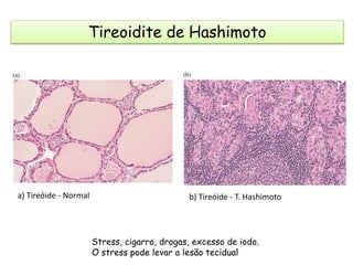 Tireoidite de Hashimoto
a) Tireóide - Normal b) Tireóide - T. Hashimoto
Stress, cigarro, drogas, excesso de iodo.
O stress pode levar a lesão tecidual
 