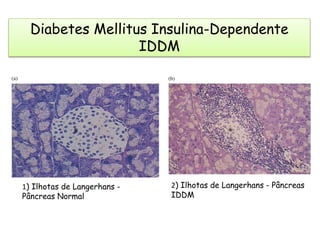 Diabetes Mellitus Insulina-Dependente
IDDM
1) Ilhotas de Langerhans -
Pâncreas Normal
2) Ilhotas de Langerhans - Pâncreas
IDDM
 