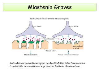 Auto-Anticorpos anti-receptor de Acetil-Colina interferem com a
transmissão neuromuscular e provocam lesão na placa motora.
Miastenia Graves
 