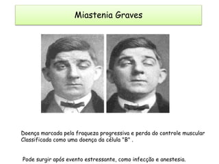 Doença marcada pela fraqueza progressiva e perda do controle muscular
Classificada como uma doença da célula "B" .
Pode surgir após evento estressante, como infecção e anestesia.
Miastenia Graves
 