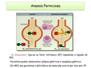 - Ac bloqueador: liga-se ao fator intrínseco (IF) impedindo a ligação da
B12.
-Pacientes podem desenvolver pólipos gástricos e neoplasia gástrica.
-Em 90% dos pacientes a deficiência da absorção ocorre por Acs anti-IF
Anemia Perniciosa
 