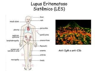 Lupus Eritematoso
Sistêmico (LES)
Anti-IgM e anti-C3b
 