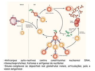 •Anticorpos auto-reativos contra constituintes nucleares: DNA,
ribonucleoproteínas, histonas e antígenos de nucléolos
•Imune-complexos se depositam nos glomérulos renais, articulações, pele e
vasos sangüíneos
 