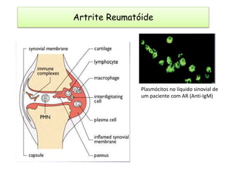 Plasmócitos no líquido sinovial de
um paciente com AR (Anti-IgM)
Artrite Reumatóide
 