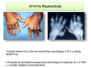 Líquido sinovial fica cheio de neutrófilos, macrófagos, LTh-1 e células
dendríticas.
Produção de metaloproteínases pelos macrófagos ativados por IL-1 e TNF-
, clivando colágeno e proteoglicanos.
Artrite Reumatóide
 