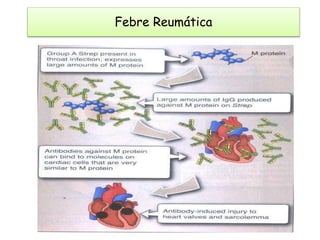 Febre Reumática
 