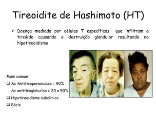 Tireoidite de Hashimoto (HT) Doença mediada por células T específicas  que infiltram a tireóide causando a destruição glandular resultando no hipotireoidismo Mais comum Ac Antitiroperoxidase = 90% Ac antitiroglobulina = 20 a 50% Hipotireoidismo subclínico Bócio 