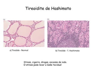 Tireoidite de Hashimoto a) Tireóide - Normal b) Tireóide - T. Hashimoto Stress, cigarro, drogas, excesso de iodo. O stress pode levar a lesão tecidual 