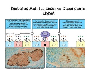 Diabetes Mellitus Insulina-Dependente  IDDM 