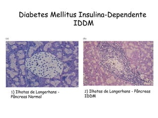 Diabetes Mellitus Insulina-Dependente  IDDM 1 ) Ilhotas de Langerhans - Pâncreas Normal 2 ) Ilhotas de Langerhans - Pâncreas IDDM 