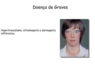 Hipertireoidismo, oftalmopatia e dermopatia  inflitrativa.  Doença de Graves 