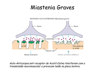Auto-Anticorpos anti-receptor de Acetil-Colina interferem com a transmissão neuromuscular e provocam lesão na placa motora. Miastenia Graves 