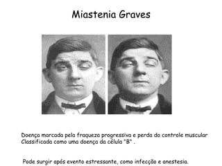 Miastenia Graves Doença marcada pela fraqueza progressiva e perda do controle muscular Classificada como uma doença da célula "B" . Pode surgir após evento estressante, como infecção e anestesia. 