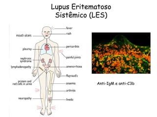 Lupus Eritematoso Sistêmico (LES) Anti-IgM e anti-C3b 