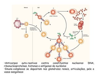 Anticorpos auto-reativos contra constituintes nucleares: DNA, ribonucleoproteínas, histonas e antígenos de nucléolos Imune-complexos se depositam nos glomérulos renais, articulações, pele e vasos sangüíneos 