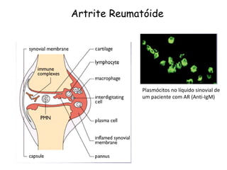 Artrite Reumatóide Plasmócitos no líquido sinovial de um paciente com AR (Anti-IgM) 