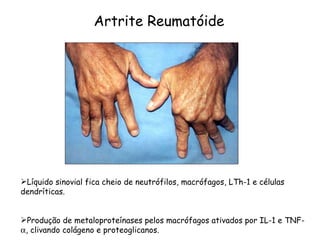Artrite Reumatóide Líquido sinovial fica cheio de neutrófilos, macrófagos, LTh-1 e células dendríticas. Produção de metaloproteínases pelos macrófagos ativados por IL-1 e TNF-  , clivando colágeno e proteoglicanos. 