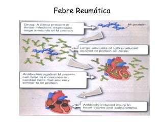 Febre Reumática 