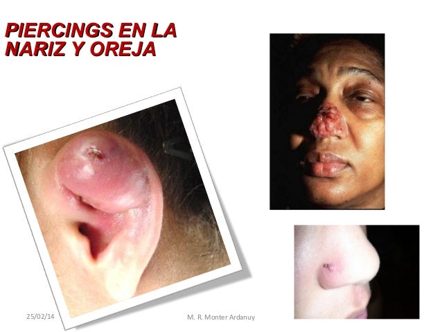 La psoriasis influye sobre la esterilidad a los hombres