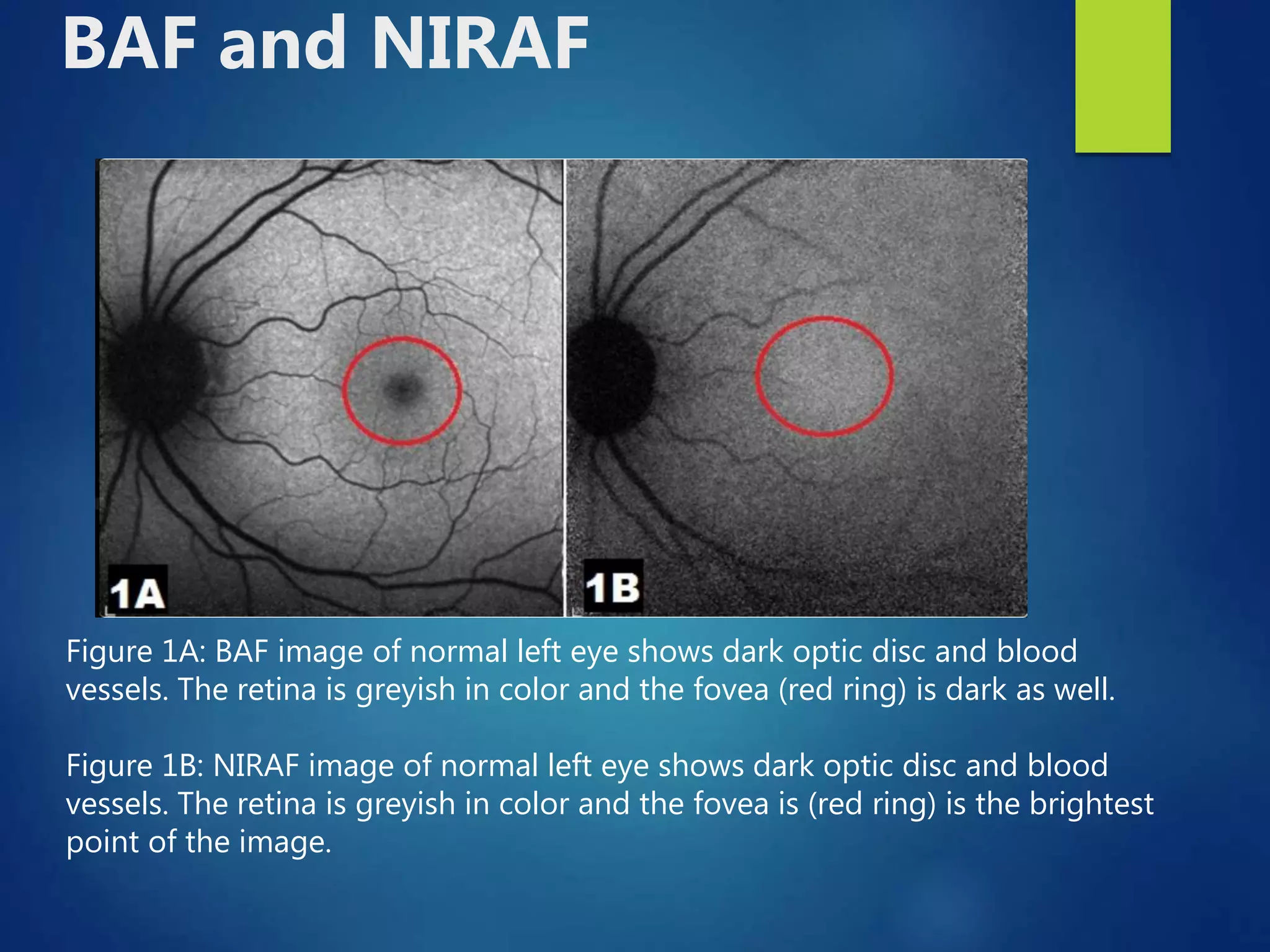 FUNDUS AUTOFLUORESCENCE | PPTX