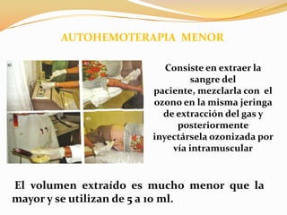      AUTOHEMOTERAPIA  MENORConsiste en extraer la sangre del paciente, mezclarla con  el ozono en la misma jeringa de extracción del gas y posteriormente inyectársela ozonizada por vía intramuscularEl volumen extraído es mucho menor que la mayor y se utilizan de 5 a 10 ml.