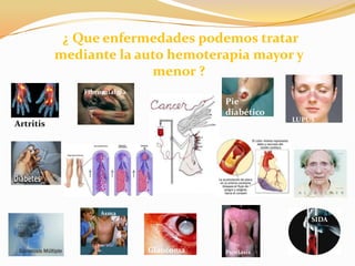 ¿ Que enfermedades podemos tratar mediante la auto hemoterapia mayor y menor ?FibromialgiaPie diabéticoLUPUSArtritisAsmaSIDAGlaucomaPsoriasis