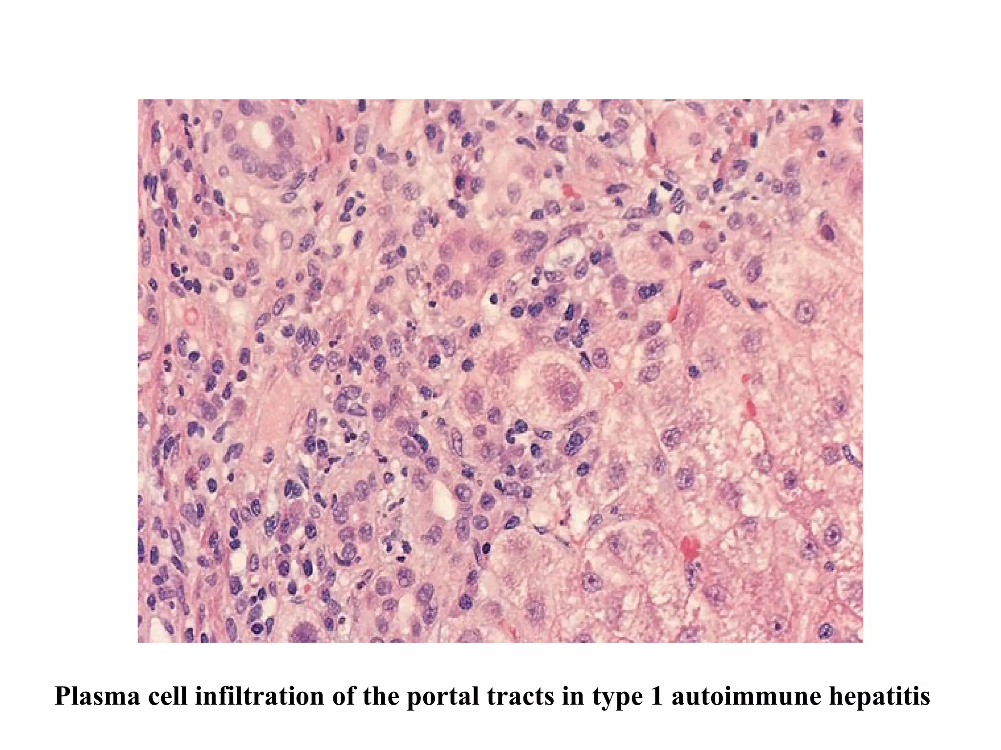 Plasma cell infiltration of the portal tracts in type 1 autoimmune hepatitis   