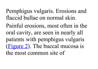 Pemphigus vulgaris. Erosions and
flaccid bullae on normal skin.
Painful erosions, most often in the
oral cavity, are seen in nearly all
patients with pemphigus vulgaris
(Figure 2). The buccal mucosa is
the most common site of
 