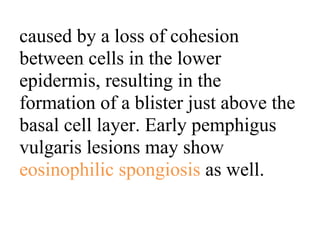 caused by a loss of cohesion
between cells in the lower
epidermis, resulting in the
formation of a blister just above the
basal cell layer. Early pemphigus
vulgaris lesions may show
eosinophilic spongiosis as well.
 