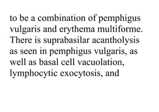 to be a combination of pemphigus
vulgaris and erythema multiforme.
There is suprabasilar acantholysis
as seen in pemphigus vulgaris, as
well as basal cell vacuolation,
lymphocytic exocytosis, and
 