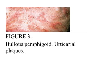 FIGURE 3.
Bullous pemphigoid. Urticarial
plaques.
 