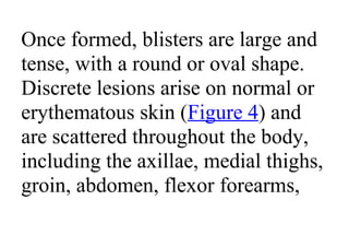 Once formed, blisters are large and
tense, with a round or oval shape.
Discrete lesions arise on normal or
erythematous skin (Figure 4) and
are scattered throughout the body,
including the axillae, medial thighs,
groin, abdomen, flexor forearms,
 