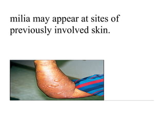 milia may appear at sites of
previously involved skin.
 