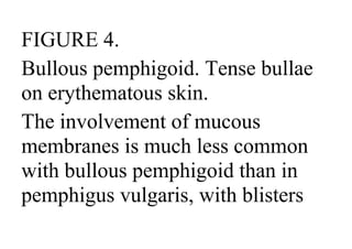 FIGURE 4.
Bullous pemphigoid. Tense bullae
on erythematous skin.
The involvement of mucous
membranes is much less common
with bullous pemphigoid than in
pemphigus vulgaris, with blisters
 