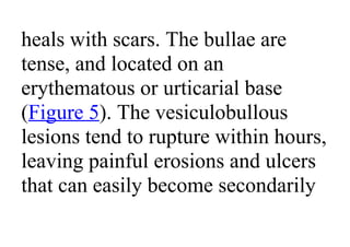 heals with scars. The bullae are
tense, and located on an
erythematous or urticarial base
(Figure 5). The vesiculobullous
lesions tend to rupture within hours,
leaving painful erosions and ulcers
that can easily become secondarily
 