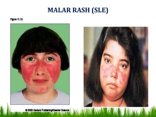 MALAR RASH (SLE)
 