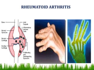 RHEUMATOID ARTHRITIS
 