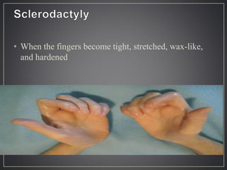 • When the fingers become tight, stretched, wax-like,
and hardened
 