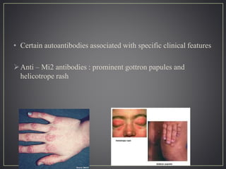 • Certain autoantibodies associated with specific clinical features
Anti – Mi2 antibodies : prominent gottron papules and
helicotrope rash
 