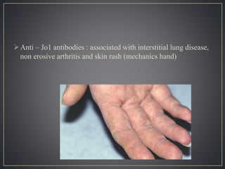 Anti – Jo1 antibodies : associated with interstitial lung disease,
non erosive arthritis and skin rash (mechanics hand)
 