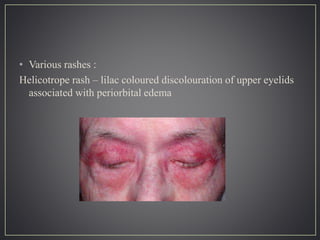 • Various rashes :
Helicotrope rash – lilac coloured discolouration of upper eyelids
associated with periorbital edema
 