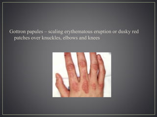 Gottron papules – scaling erythematous eruption or dusky red
patches over knuckles, elbows and knees
 