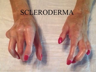 SCLERODERMA
 