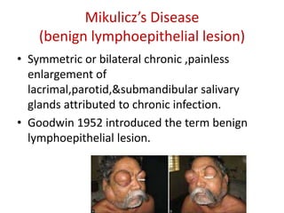 Mikulicz’s Disease
(benign lymphoepithelial lesion)
• Symmetric or bilateral chronic ,painless
enlargement of
lacrimal,parotid,&submandibular salivary
glands attributed to chronic infection.
• Goodwin 1952 introduced the term benign
lymphoepithelial lesion.
 