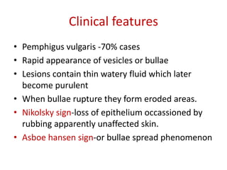 Clinical features
• Pemphigus vulgaris -70% cases
• Rapid appearance of vesicles or bullae
• Lesions contain thin watery fluid which later
become purulent
• When bullae rupture they form eroded areas.
• Nikolsky sign-loss of epithelium occassioned by
rubbing apparently unaffected skin.
• Asboe hansen sign-or bullae spread phenomenon
 
