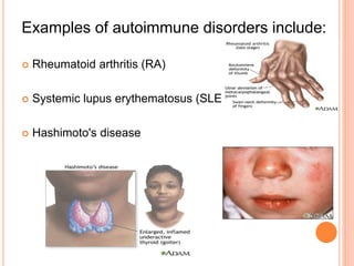 Autoimmune diseases | PPTX
