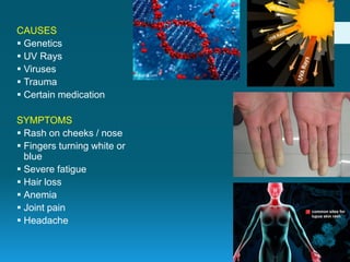 Autoimmune diseases | PPTX