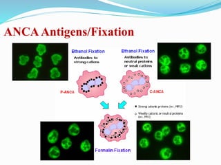 ANCAAntigens/Fixation
 