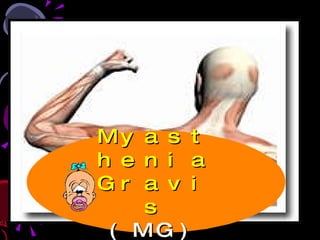 Myasthenia Gravis (MG) 